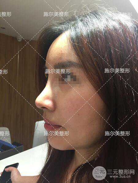 南京施爾美劉道功隆鼻案例術(shù)后恢復(fù)實(shí)記