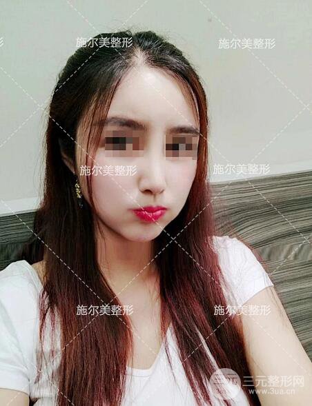 南京施爾美劉道功隆鼻案例術(shù)后恢復(fù)實(shí)記