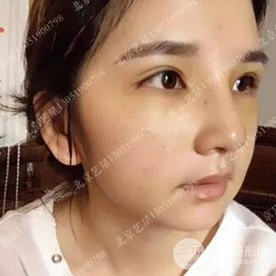 北京藝星隆鼻整形案例前后對比圖分享~