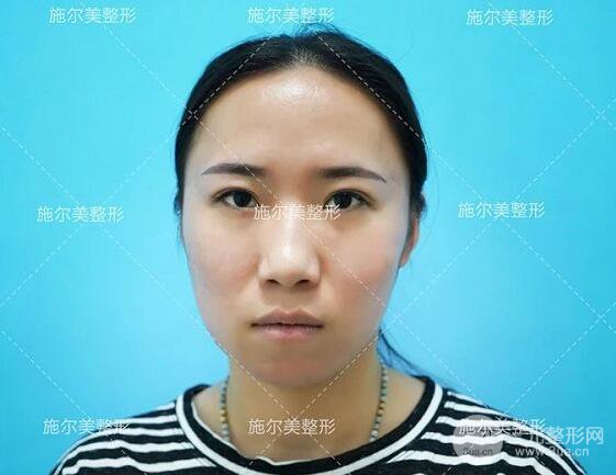 南京施爾美玻尿酸注射案例,讓蘋(píng)果肌嘭嘭嘭！