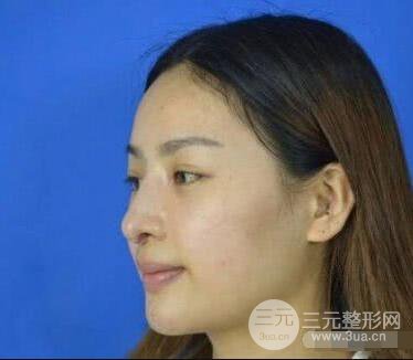 吉林銘醫(yī)李紅肋骨隆鼻整形前后對比圖果恢復心情小札