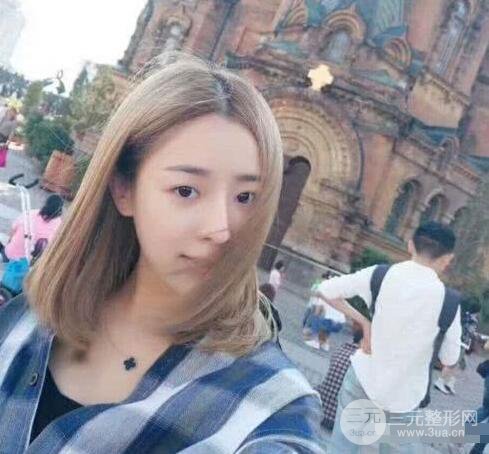 吉林銘醫(yī)李紅肋骨隆鼻整形前后對比圖果恢復心情小札