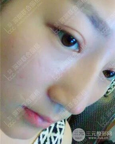 深圳聯(lián)合麗格線D隆鼻恢復(fù)日記以及前后對(duì)比圖分享！