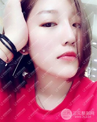 深圳聯(lián)合麗格線D隆鼻恢復(fù)日記以及前后對(duì)比圖分享！