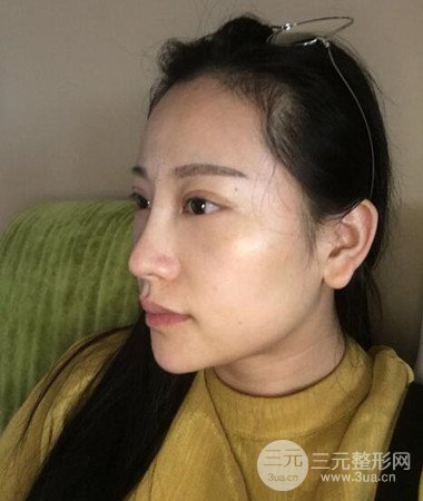 內(nèi)切微創(chuàng)去眼袋手術(shù)案例分享，附上手術(shù)恢復(fù)照片