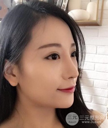 內(nèi)切微創(chuàng)去眼袋手術(shù)案例分享，附上手術(shù)恢復(fù)照片