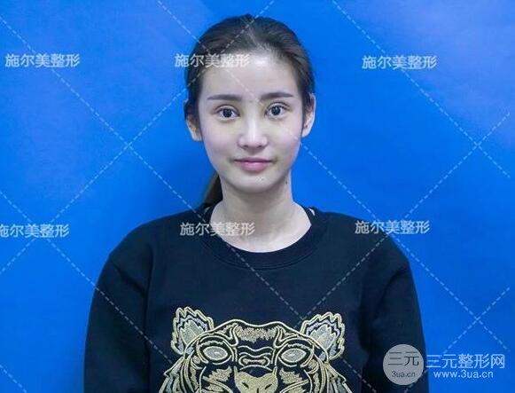 南京施爾美雙眼皮+隆鼻案例術(shù)后恢復(fù)日記