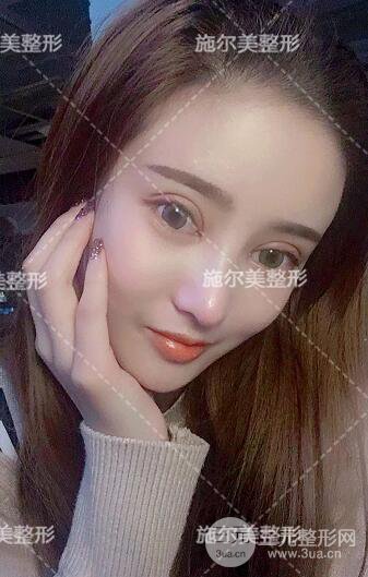 南京施爾美雙眼皮+隆鼻案例術(shù)后恢復(fù)日記