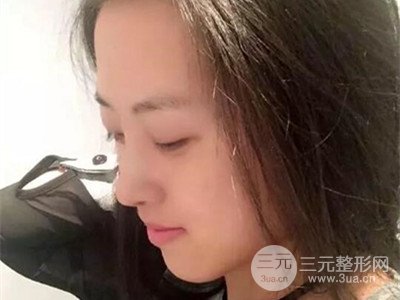 長(zhǎng)沙鵬愛彭正春假體隆鼻案例分享