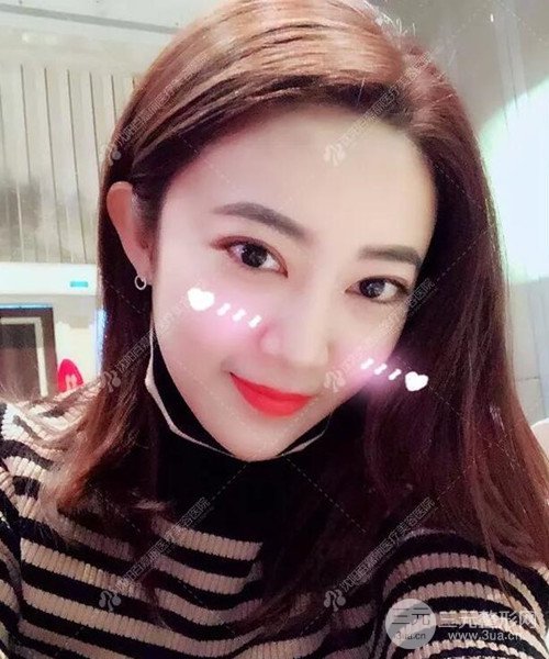 沈陽百嘉麗雙眼皮+開眼角恢復(fù)日記以及前后對(duì)比圖分享~