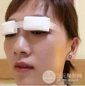 吉林銘醫(yī)李紅雙眼皮修復前后對比圖 內(nèi)附吉林銘醫(yī)小彩蛋哦