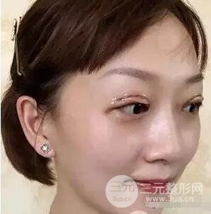 吉林銘醫(yī)李紅雙眼皮修復前后對比圖 內(nèi)附吉林銘醫(yī)小彩蛋哦