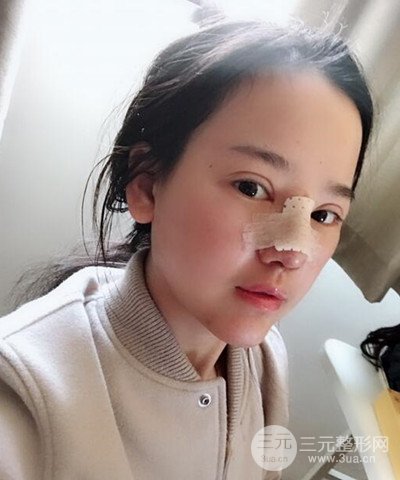 做了隆鼻整形成功落實精致小巧鼻 附上果圖