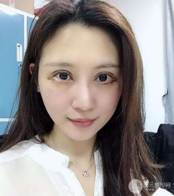 蘭大二院張選奮怎么樣?雙眼皮修復(fù)案例前后對比圖