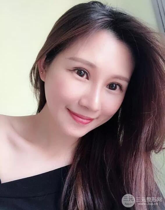 蘭大二院張選奮怎么樣?雙眼皮修復(fù)案例前后對比圖