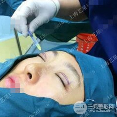 上海藝星雙眼皮日記分享，割雙眼皮后大變樣！