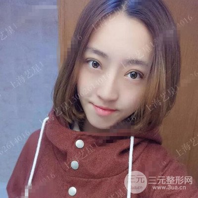 上海藝星雙眼皮日記分享，割雙眼皮后大變樣！
