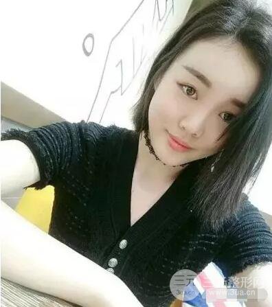 成都玉之光自體脂肪面部填充劉中國真人案例反饋|內(nèi)附對比前后照