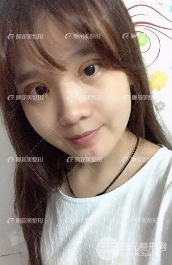 南京施爾美整形孫欣雙眼皮案例恢復(fù)日記