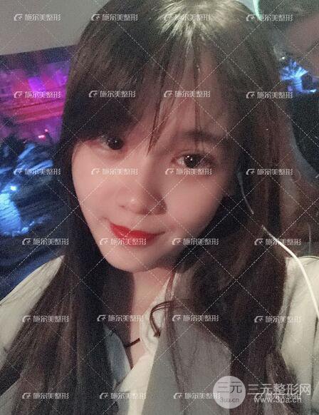 南京施爾美整形孫欣雙眼皮案例恢復(fù)日記