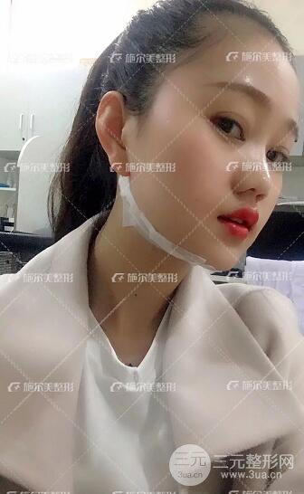 南京施爾美整形孫欣線(xiàn)D案例,重返17歲！