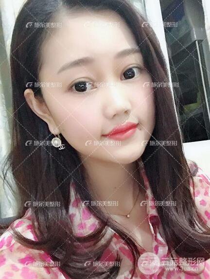 南京施爾美整形孫欣線(xiàn)D案例,重返17歲！