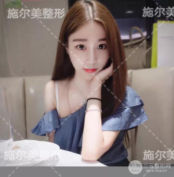 南京施爾美自體脂肪填充案例,拒絕“壽星公”！