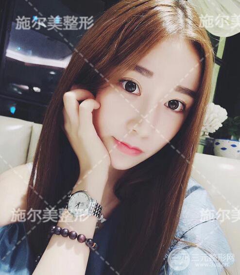 南京施爾美自體脂肪填充案例,拒絕“壽星公”！