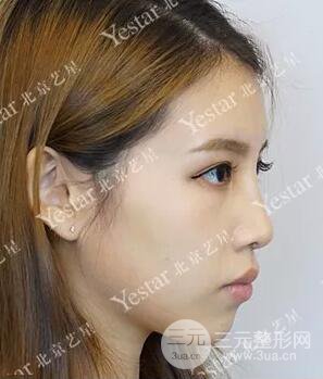 北京藝星仇侃敏耳軟骨隆鼻恢復過程|內附前后對比圖