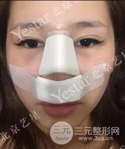 北京藝星仇侃敏耳軟骨隆鼻恢復過程|內附前后對比圖