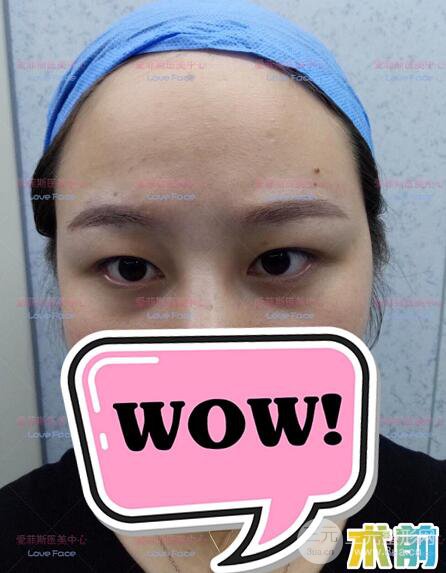 揚(yáng)州艾菲斯黃嬋院長雙眼皮案例術(shù)后七天果