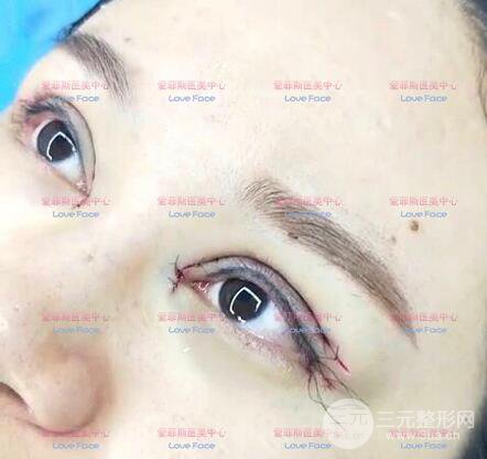 揚(yáng)州艾菲斯黃嬋院長雙眼皮案例術(shù)后七天果