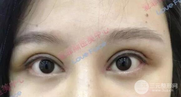 揚(yáng)州艾菲斯黃嬋院長雙眼皮案例術(shù)后七天果