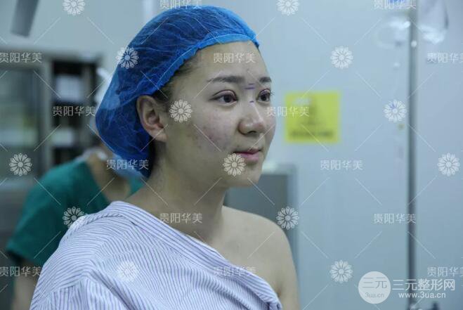貴陽(yáng)華美牛勇敢全切雙眼皮+假體隆鼻案例前后對(duì)比圖 華美員工全臉整形實(shí)錄