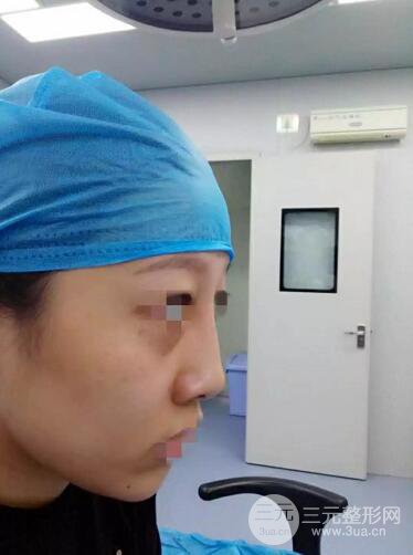 揚(yáng)州艾菲斯整形隆鼻案例，自拍盛顏不是夢！