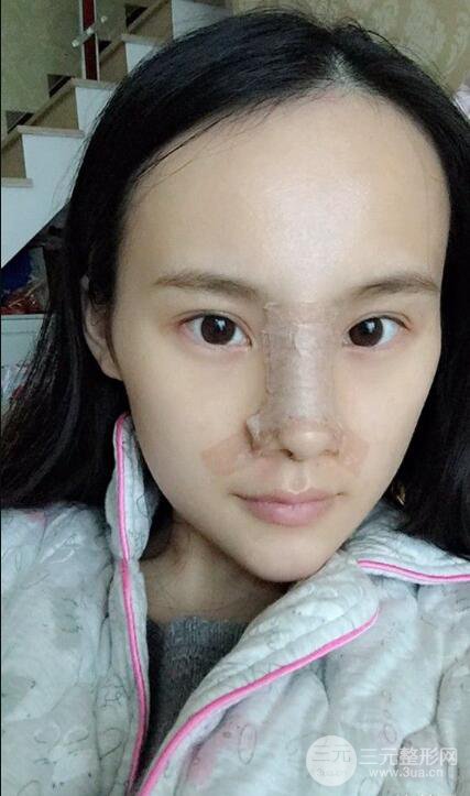 成都大華隆鼻怎么樣?真實案例前后對比圖記錄恢復過程