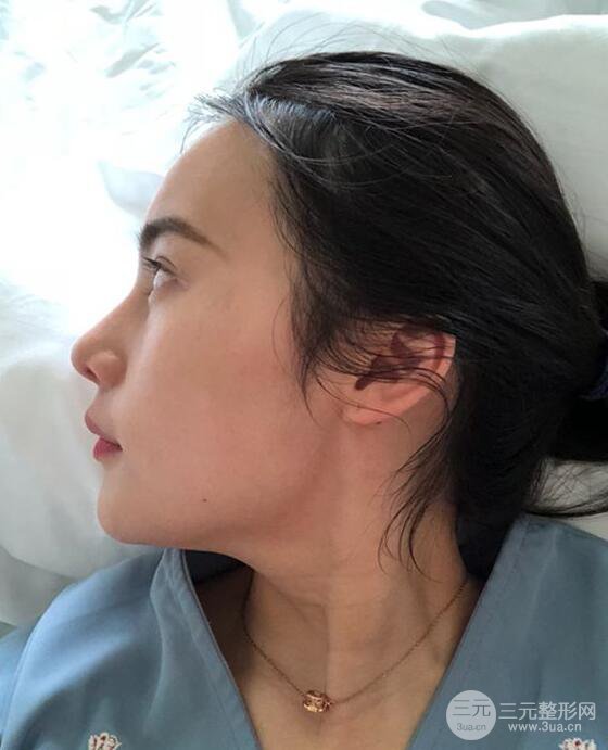 成都大華隆鼻怎么樣?真實案例前后對比圖記錄恢復過程