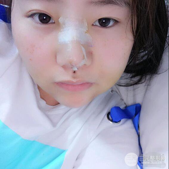 合肥壹加壹甘泉涌軟骨隆鼻前后對比圖|內(nèi)附真人案例恢復過程