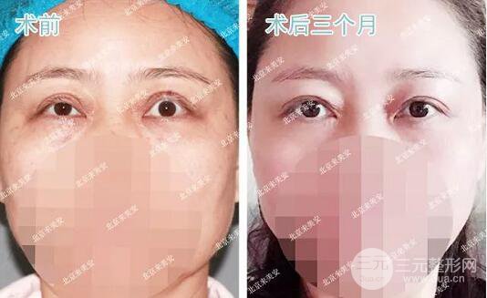 北京來美安王振軍雙眼皮修復(fù)整形案例