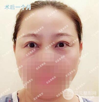北京來美安王振軍雙眼皮修復(fù)整形案例