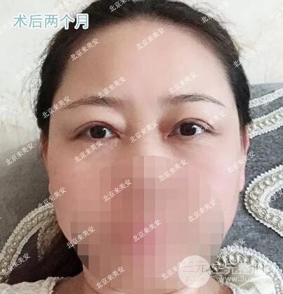 北京來美安王振軍雙眼皮修復(fù)整形案例
