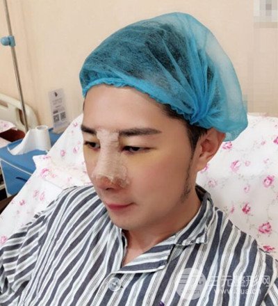 肋軟骨隆鼻整形案例分享，在深圳雅涵做的!