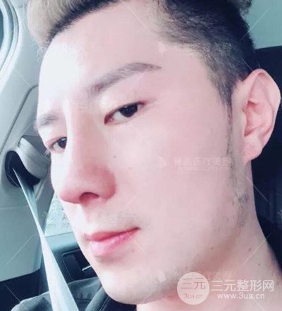 肋軟骨隆鼻整形案例分享，在深圳雅涵做的!