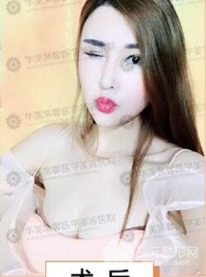 四川華美紫馨自體脂肪豐胸前后對(duì)比圖，術(shù)后果驚人!