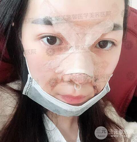 四川成都華美艾玉峰隆鼻修復(fù)案例術(shù)后恢復(fù)圖