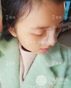 成都素美假體隆鼻案例前后對比圖分享!