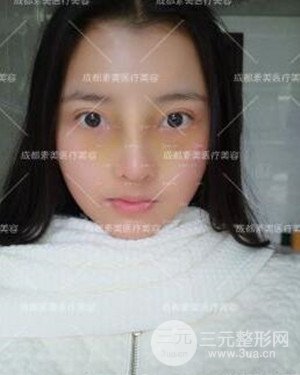 成都素美假體隆鼻案例前后對比圖分享!