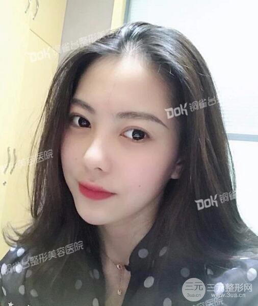 重慶銅雀臺玻尿酸注射填充案例圖片