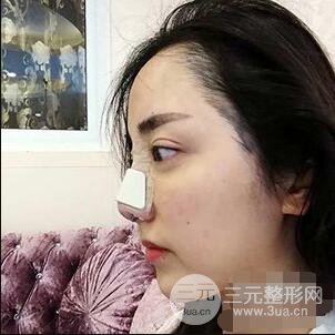 杭州格萊美張樹功假體隆鼻前后對比圖|內(nèi)附恢復(fù)心情變化哦