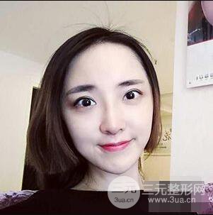 杭州格萊美張樹功假體隆鼻前后對比圖|內(nèi)附恢復(fù)心情變化哦